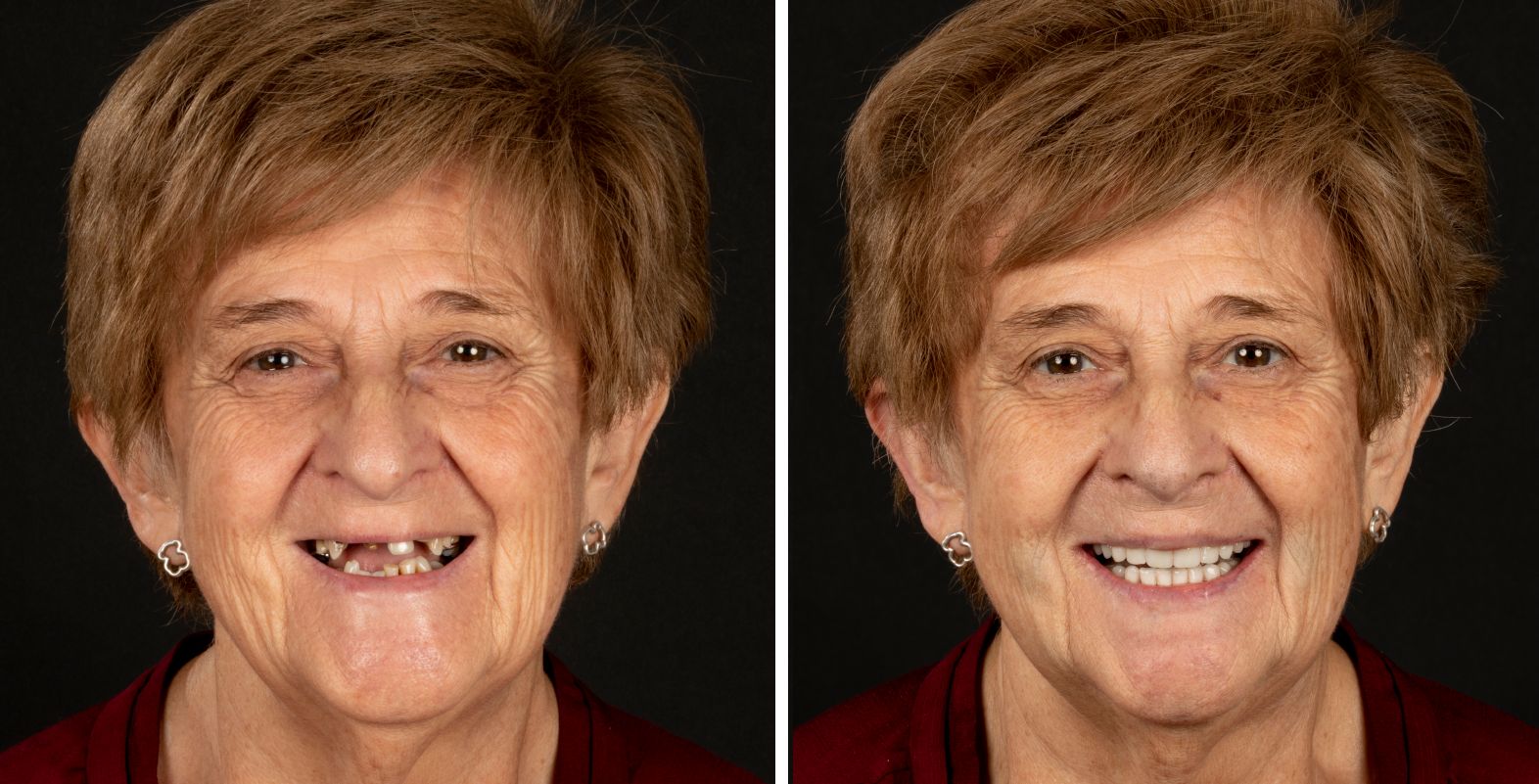 Antes y después de implantes dentales
