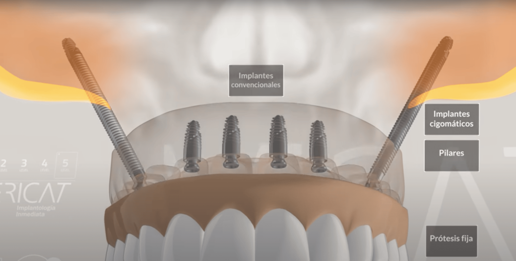 Implantes cigomáticos Vericat implantología Inmediata