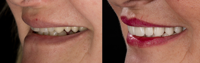 Antes y después de la implantología dental en Vericat