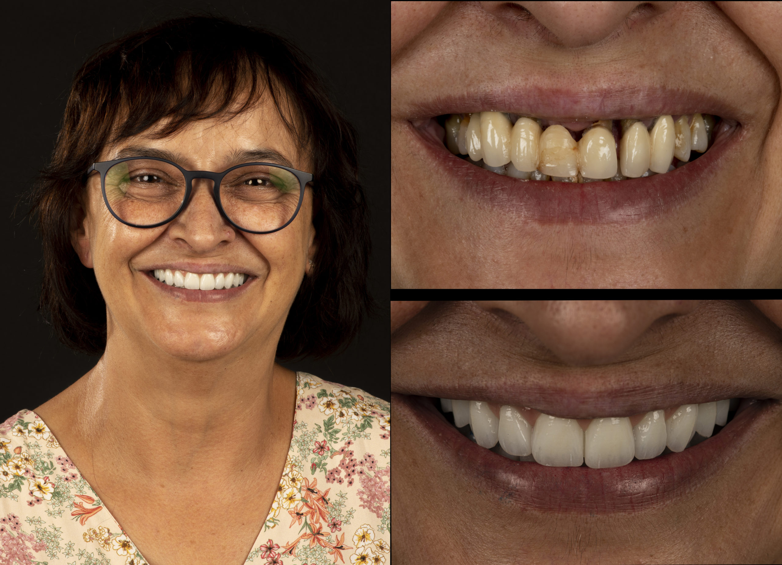 Antes y después de tratamiento de implantes dentales