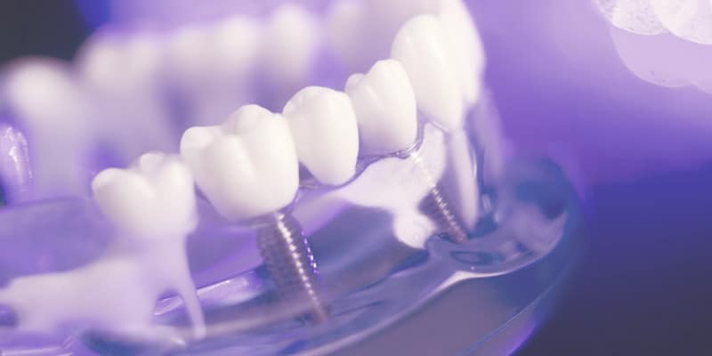 Síntomas rechazo implante dental