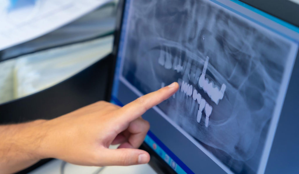 Radiografía implantes dentales cigomáticos