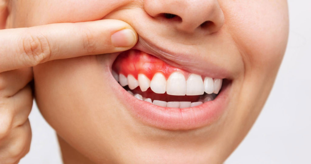 Gingivitis, inflamación de las encías