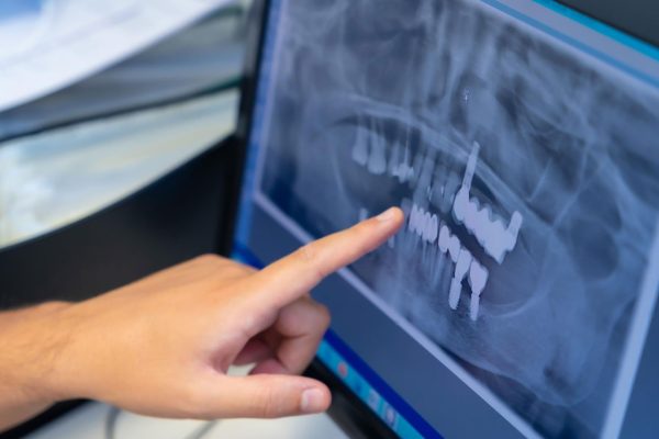 Radiografía implantes dentales cigomáticos